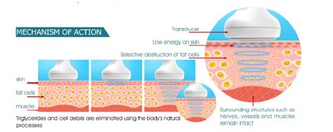 fat cavitation northbridge|Effects of Ultracavitation and Radiofrequency on Abdominal .